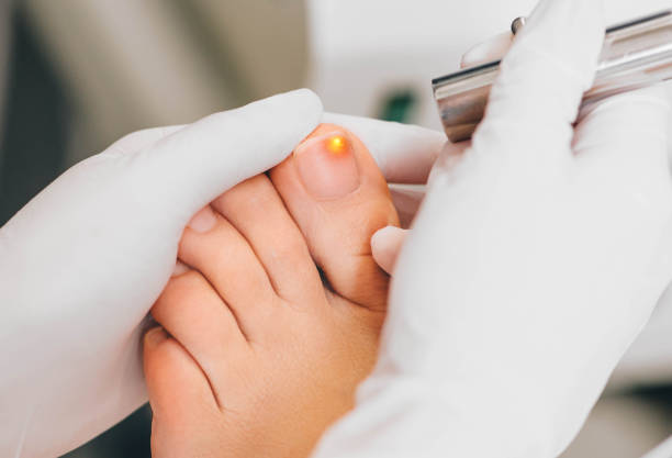 Nail Fungus Laser Treatment Gaining Popularity in Melbourne